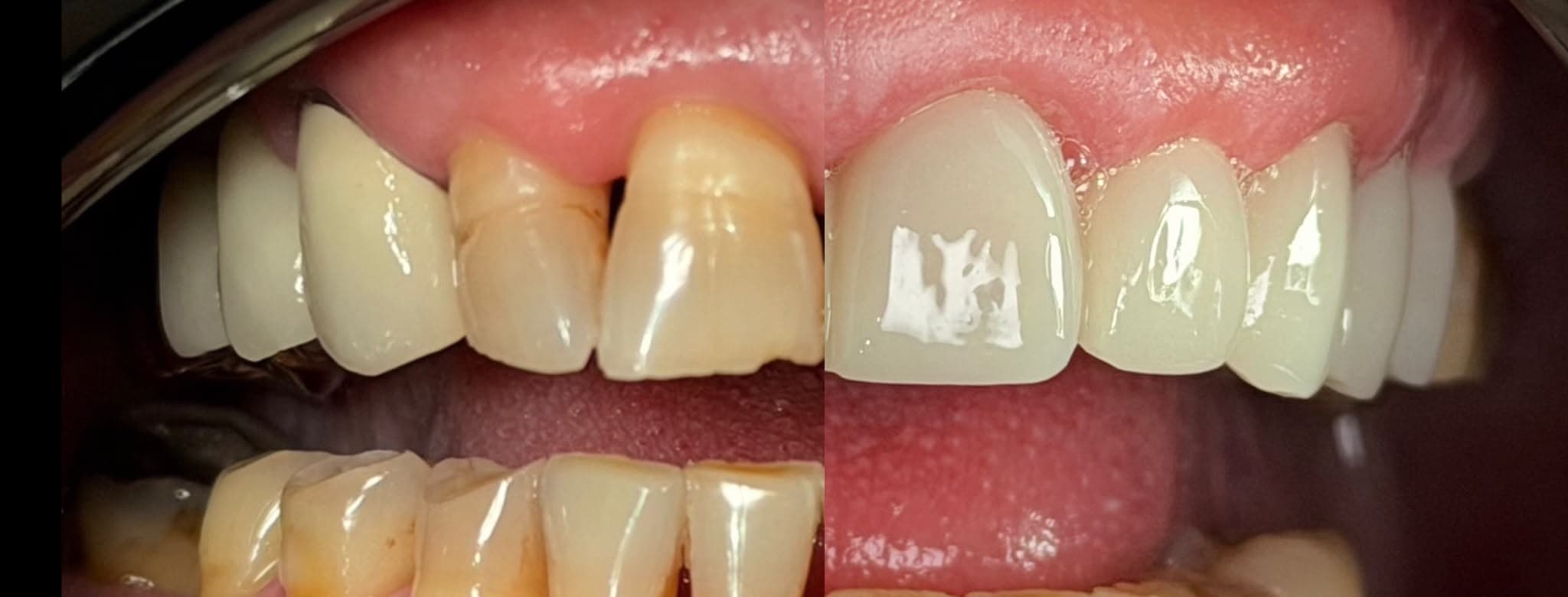 Lucrare dentară, înainte și după, vedere de detaliu