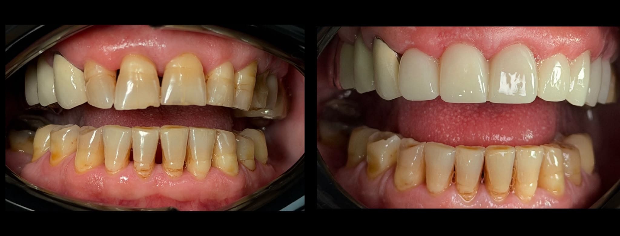 Lucrare dentară, înainte și după, vedere frontală