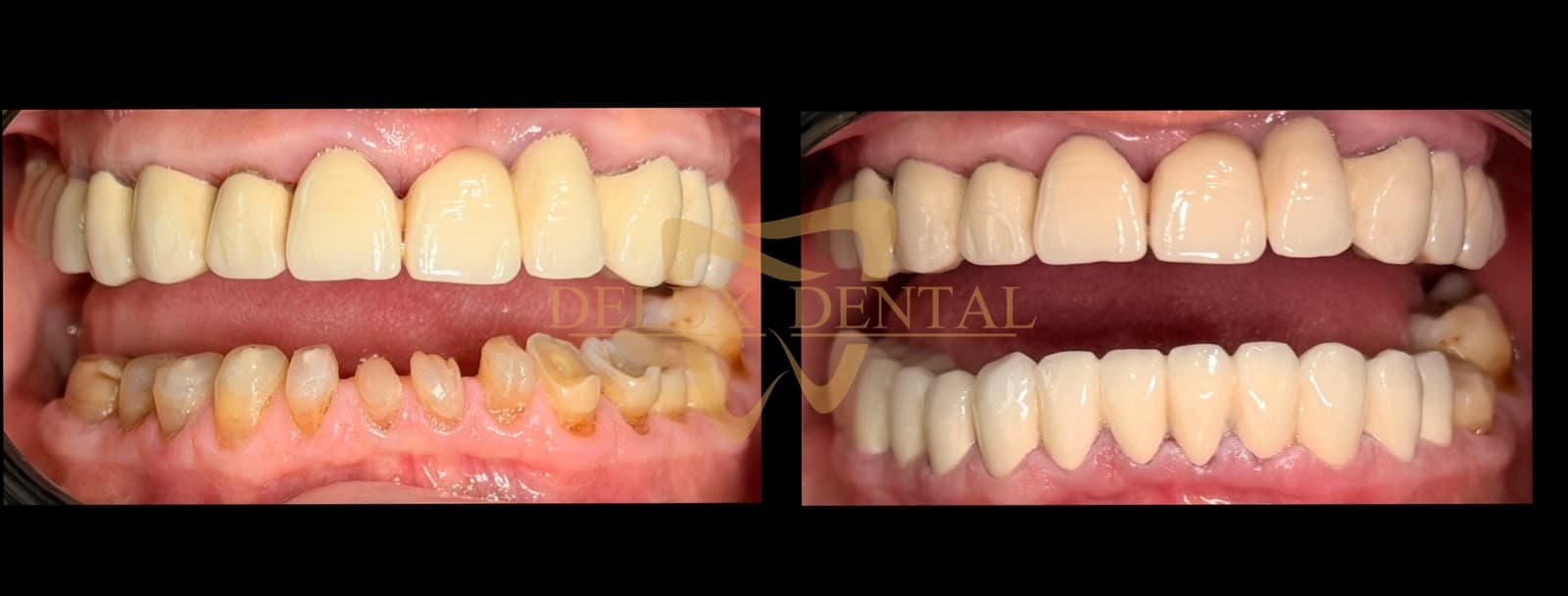 Caz tratat la Delux Dental, înainte și după (1)