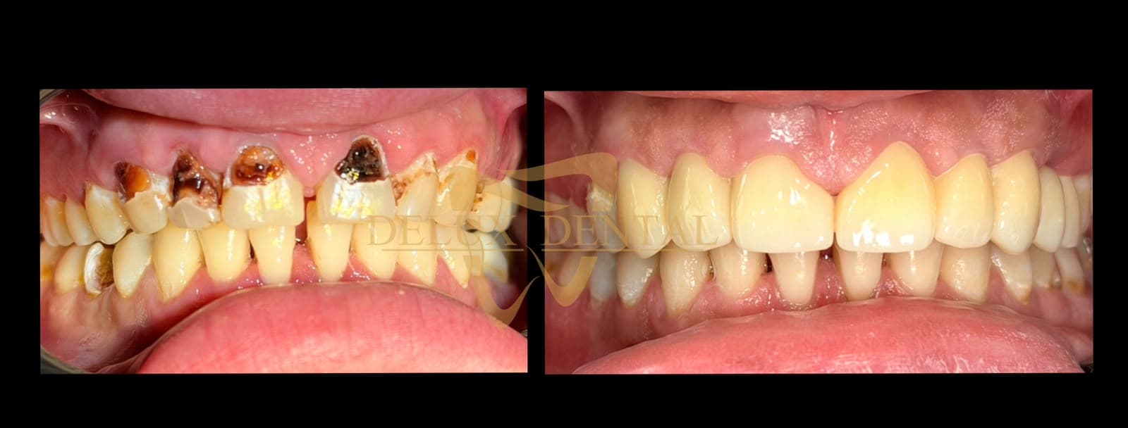 Caz tratat la Delux Dental, înainte și după (2)
