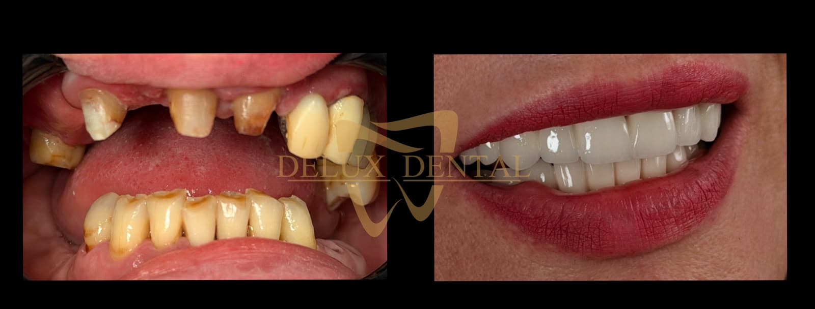 Caz tratat la Delux Dental, înainte și după (3)