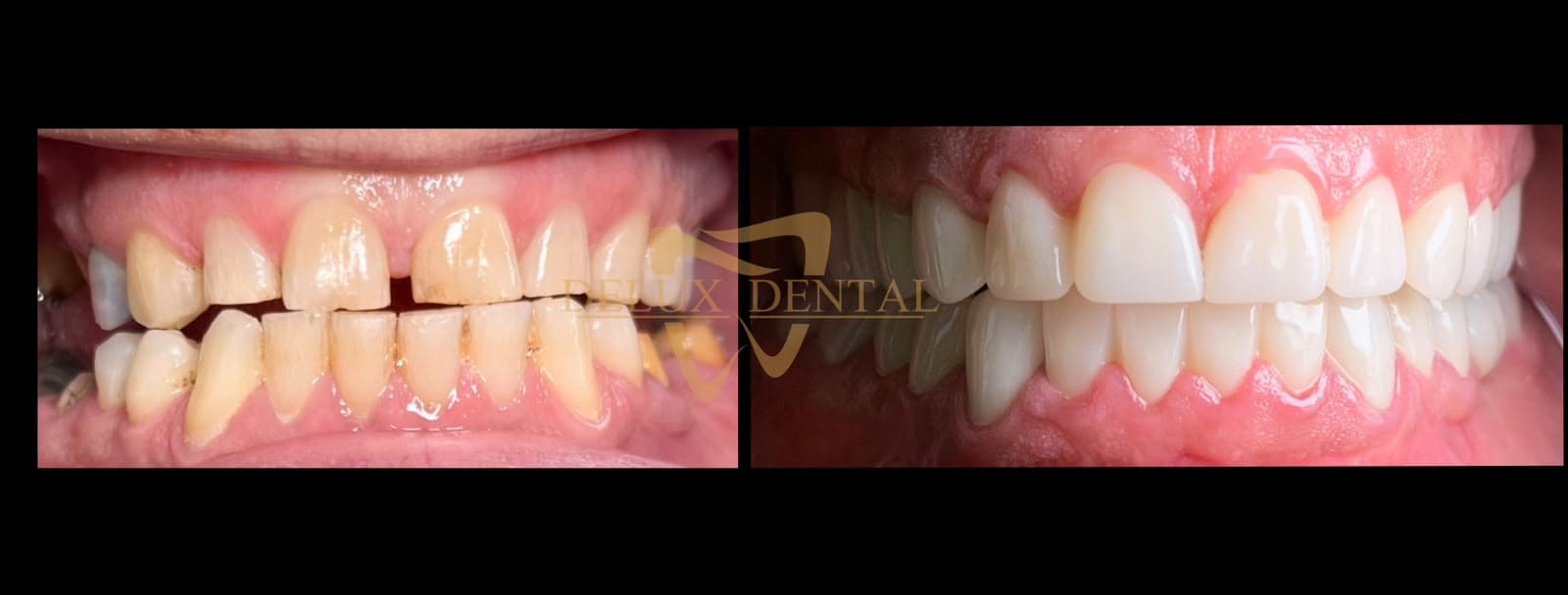 Caz tratat la Delux Dental, înainte și după (4)
